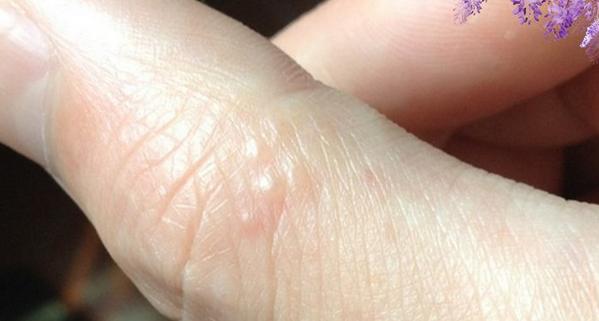 很多人都沒發現！！「手指」突然出現這種小水泡…竟是大病前兆！！千萬要小心了…