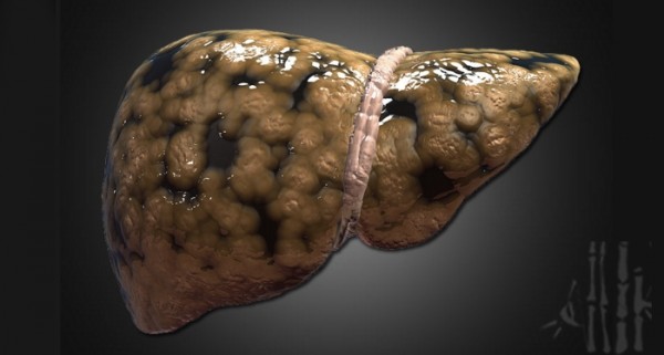 為何「肝癌」一發現就是晚期？你的肝若出現這三種症狀，就恐怖了...千萬要注意！