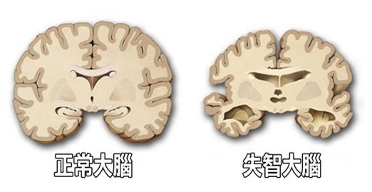 「大腦」縮水都是自己害的！不可不學的「救腦10招」：這樣做減少「失智症」發病率65%！